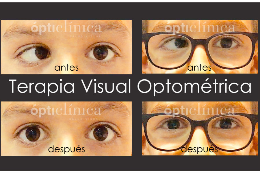 Terapia Visual Optométrica en Estrabismos